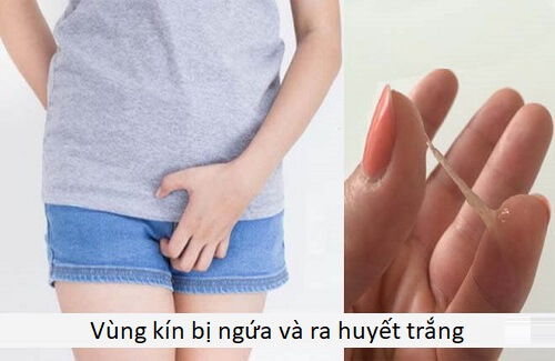 Vùng kín bị ngứa và ra huyết trắng